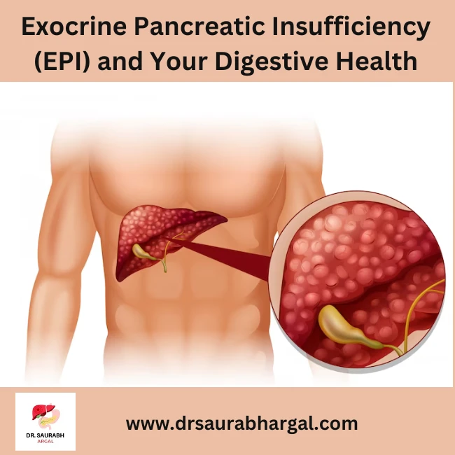 Exocrine Pancreatic Insufficiency (EPI)
