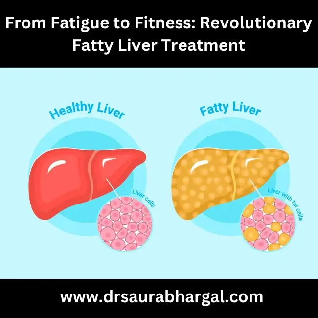 fatty liver treatment in indore