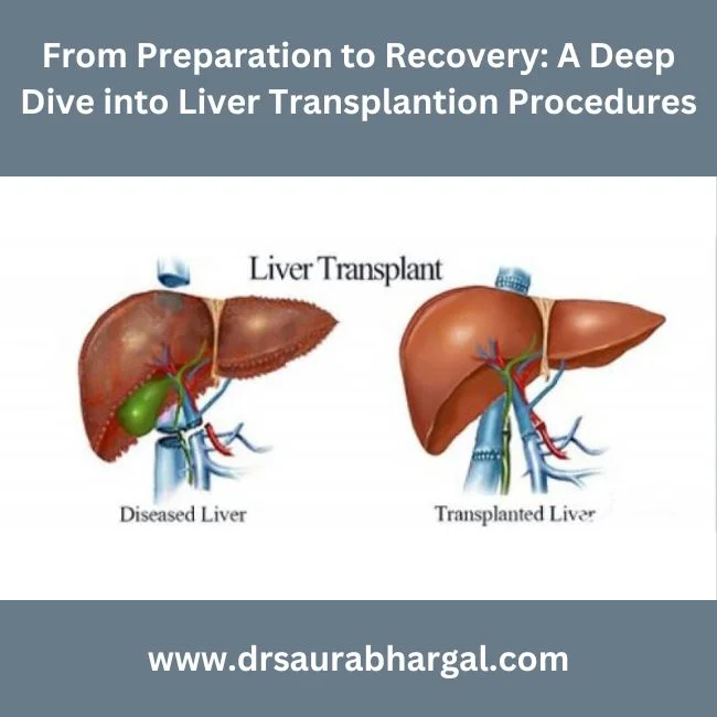 Liver transplantation